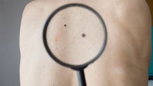 Imagem de Noventa mil casos de cancro da pele em cinco anos
