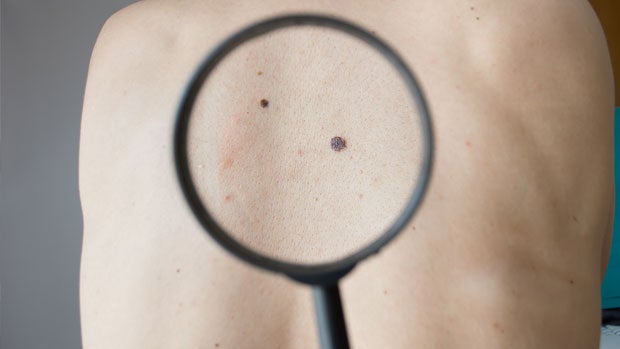 Imagem de Noventa mil casos de cancro da pele em cinco anos