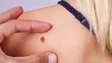 Imagem de 45 casos de melanoma na Madeira nos últimos dois anos (áudio)
