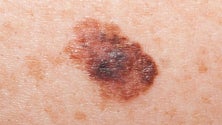 Imagem de Dia do cancro da pele assinalado na Região com rastreios gratuitos no Hospital dos Marmeleiros (Áudio)