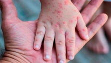 Imagem de Monkeypox: Terceiro caso confirmado na Região
