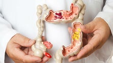 Imagem de Portugal regista 8 mil novos casos de cancro do intestino, por ano (Vídeo)