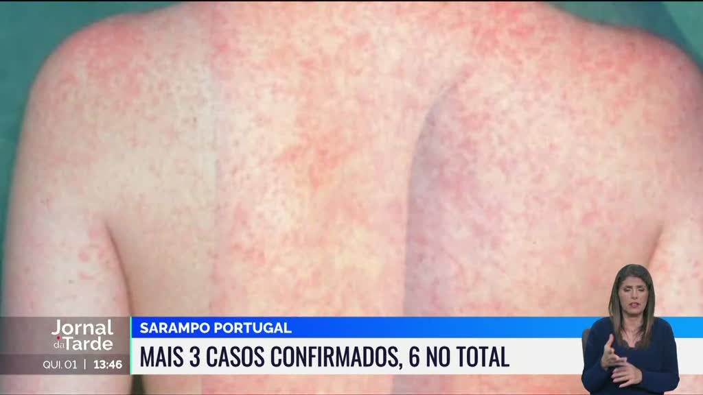 Estão confirmados mais três casos de Sarampo em Portugal