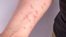 Imagem de Monkeypox: Número de casos confirmados em Portugal sobe para os 917