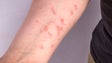 Imagem de Monkeypox: Número de casos confirmados em Portugal sobe para os 917