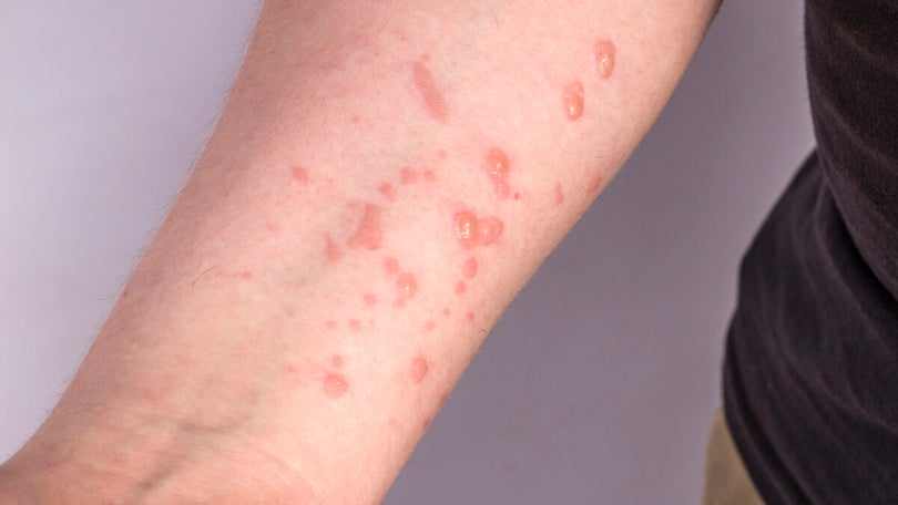 Imagem de Monkeypox: Número de casos confirmados em Portugal sobe para os 917