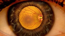 Imagem de O serviço de Saúde da Madeira já realizou mais de 19 mil exames à retinopatia
