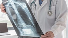 Imagem de Rastreio ao cancro do pulmão vai avançar no início de 2024