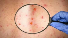 Imagem de Região regista primeiro caso de Monkeypox