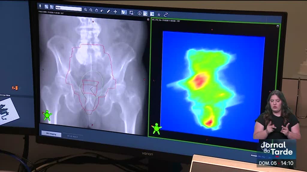 Nova técnica de radioterapia com foco direto no tumor vai poupar tecido saudável