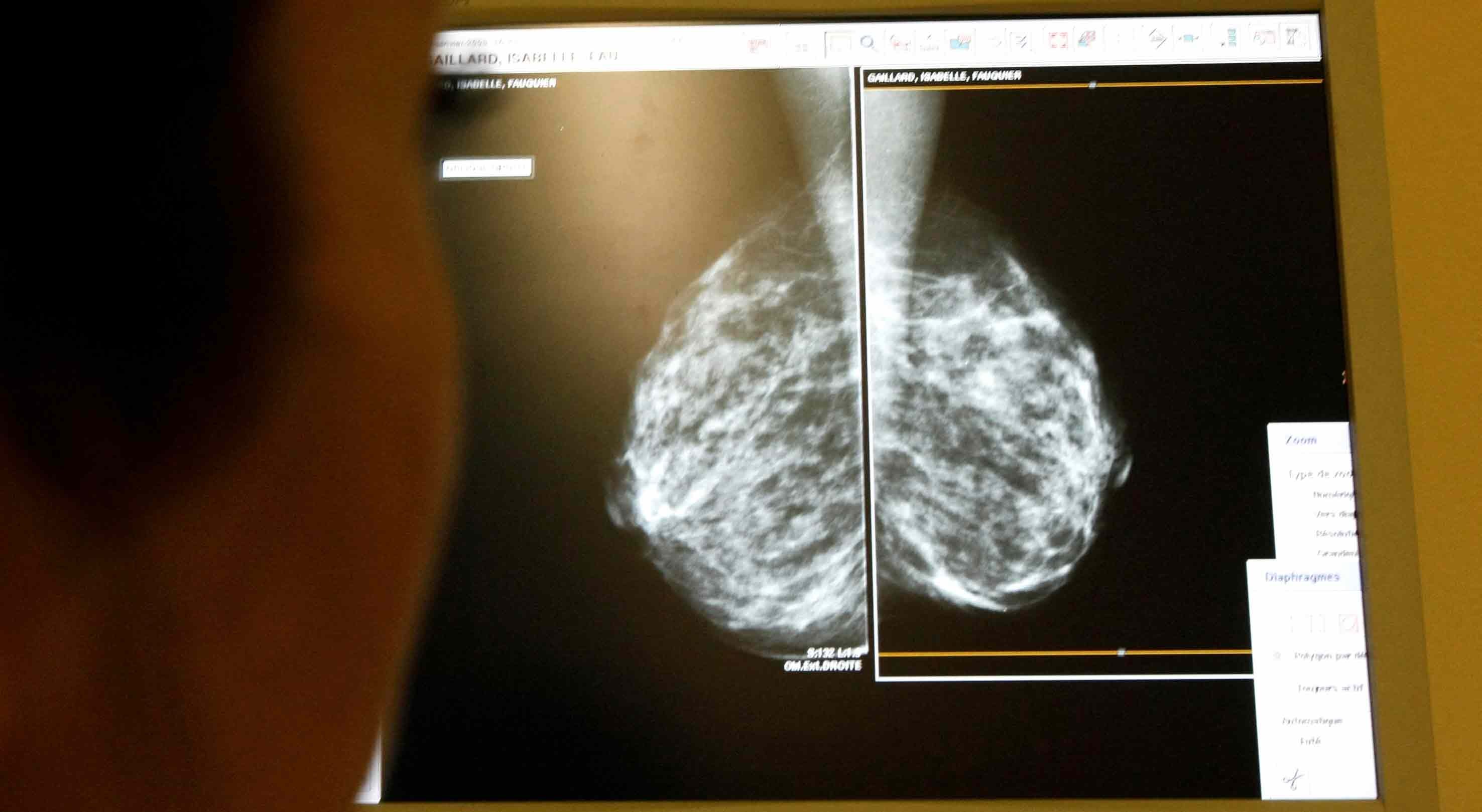 Onze tipos de cancro aumentam entre os jovens no Reino Unido e os cientistas já têm primeira pista sobre a razão