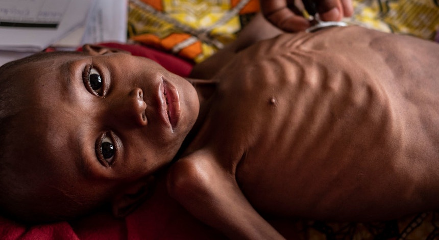 A desnutrição afeta cada vez mais crianças
