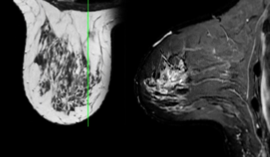 Variante de proteína que pode ajudar a controlar o cancro descoberta pela Universidade de Coimbra