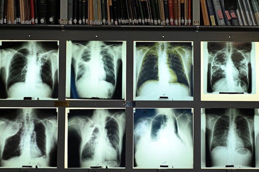 Imagem de Portugal registou número de casos de tuberculose mais baixo de sempre