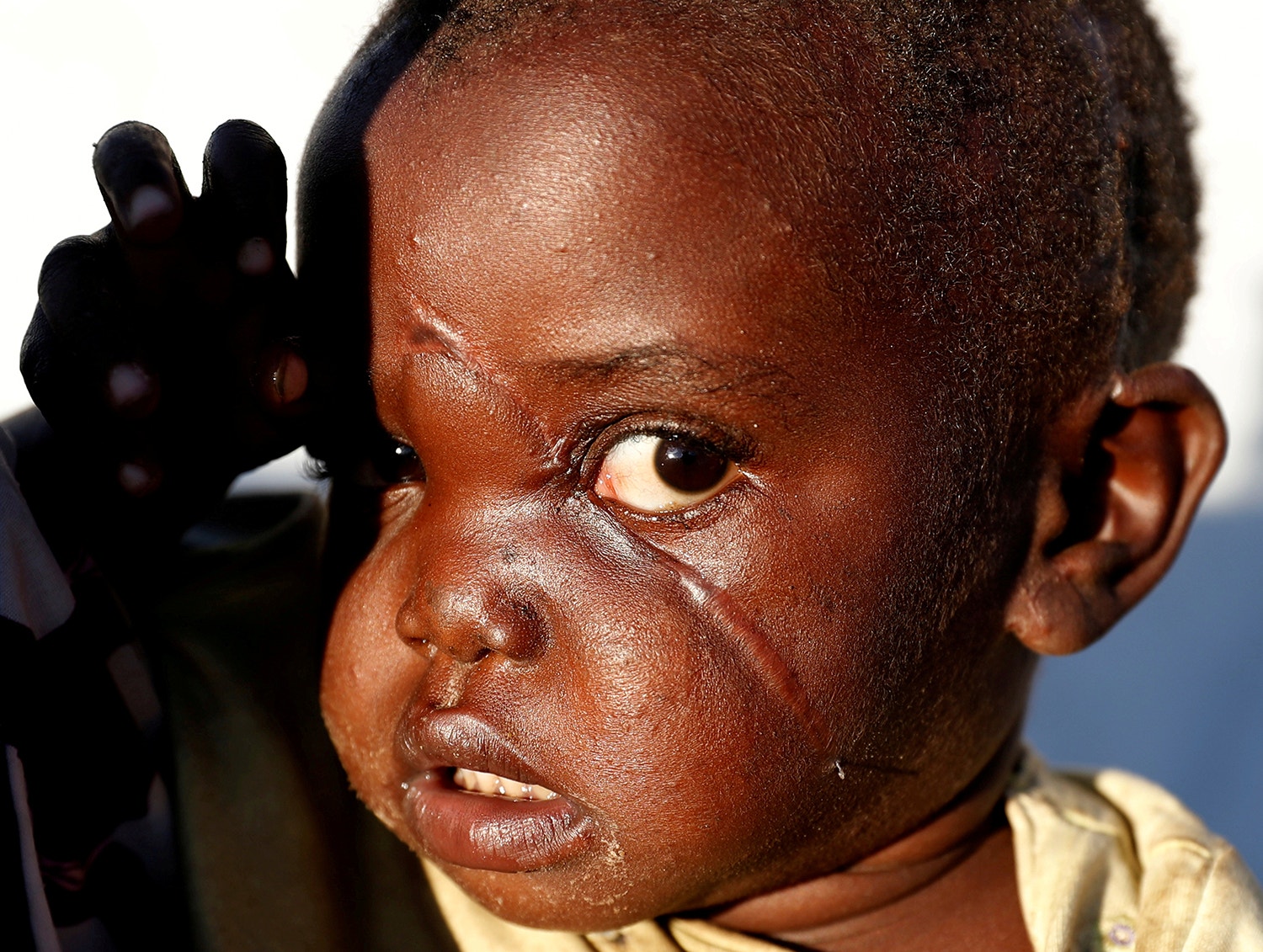  Rachele-Ngabausi de 2 anos ficou ferido devido a um ataque de mil&iacute;cias &agrave; sua aldeia em Bunia na Rep. Democr&aacute;tica do Congo /Goran Tomasevic - Reuters 