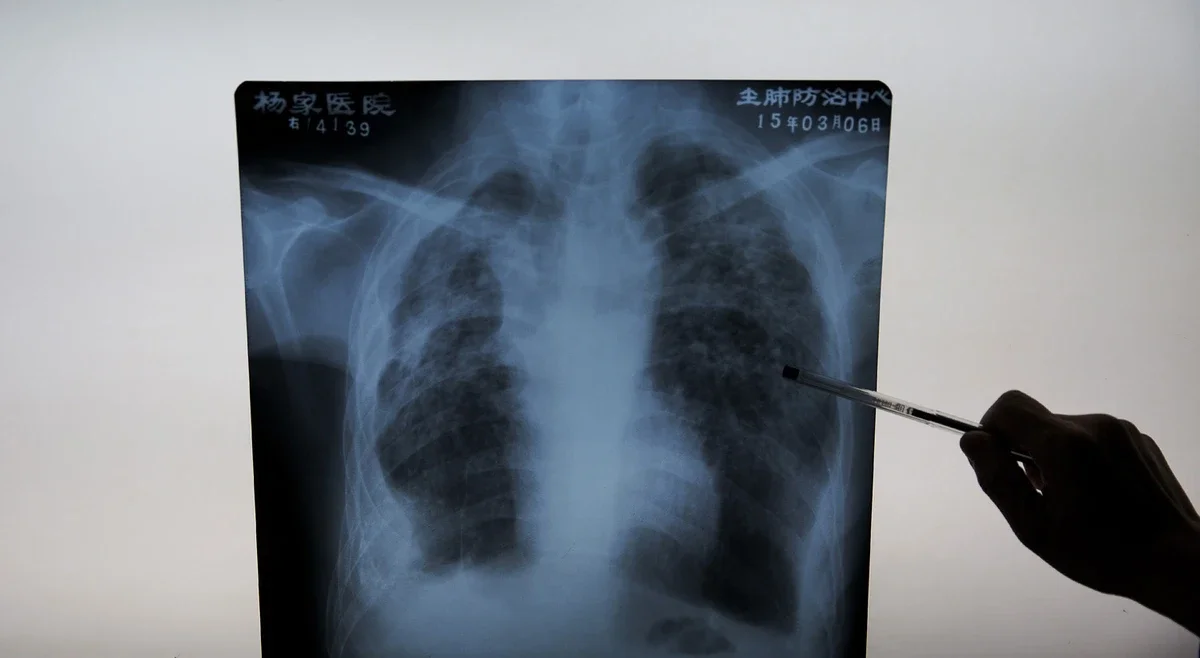 ULS Santa Maria ready to launch pilot lung cancer screening project