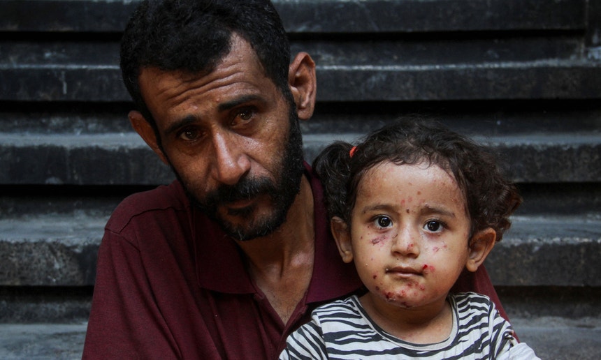 Yasmine Al-Shanbari, uma menina palestiniana com uma infeção de pele, junto do pai. Localidade de Jabalia, no norte da Faixa de Gaza
