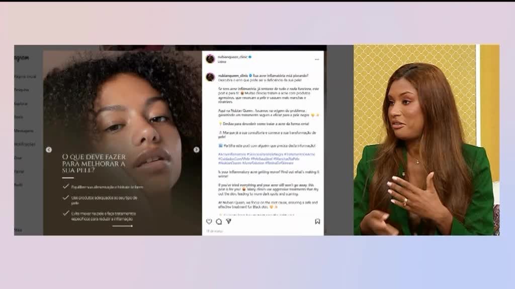 Imagem de Viva Saúde - Acne Inflamatória nos Adultos