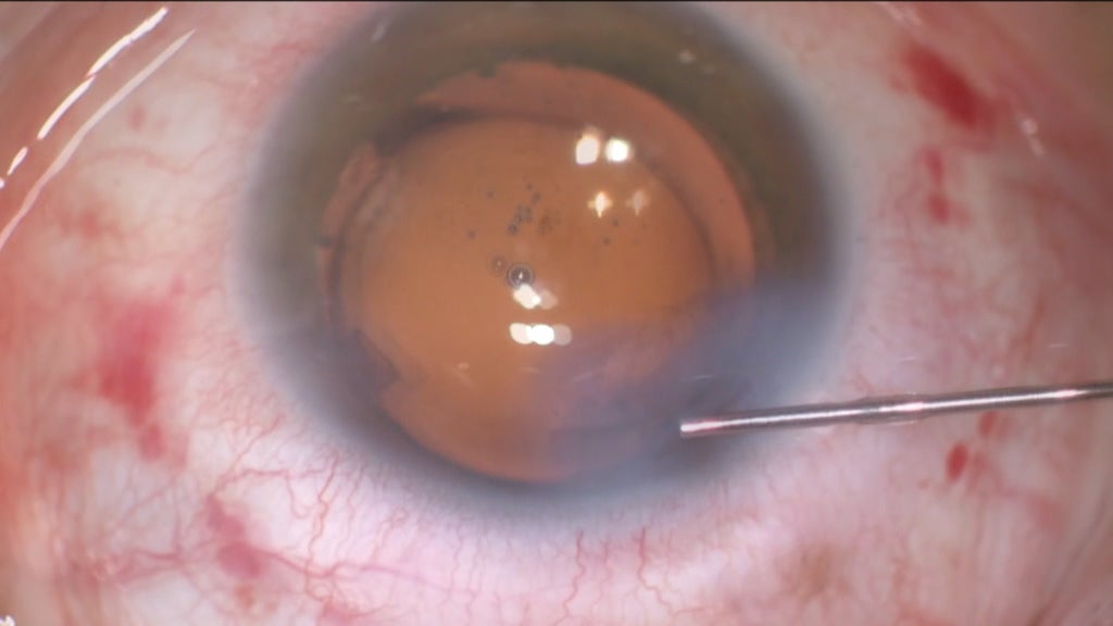 Infeções oculares no Hospital Egas Moniz