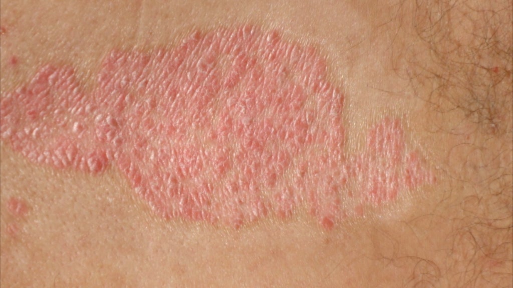 Dia Mundial Psoríase