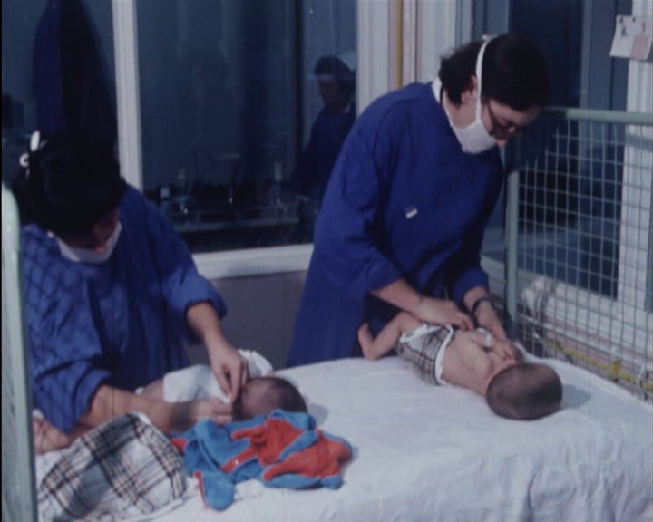 Gémeas siamesas separadas