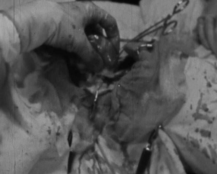 Transplante de coração no Sanatório Dom Carlos I em Lisboa