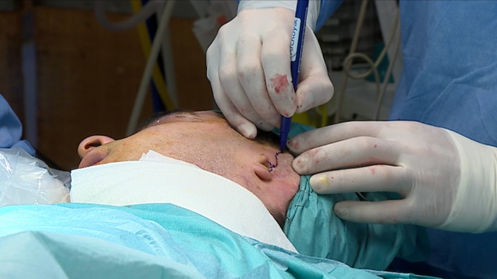 Implante de orelha inovador e pioneiro