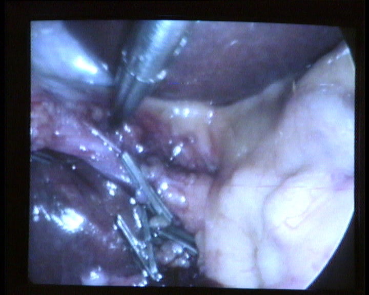 Cirurgia video endoscópica