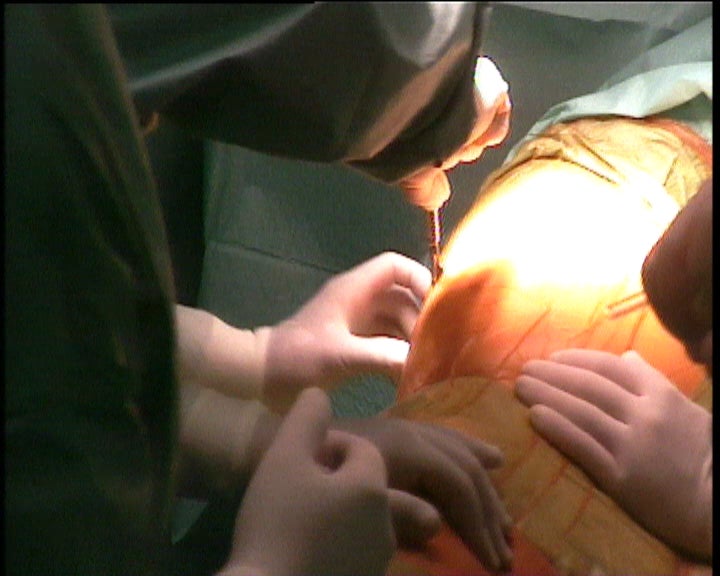 Transplante de Pulmão